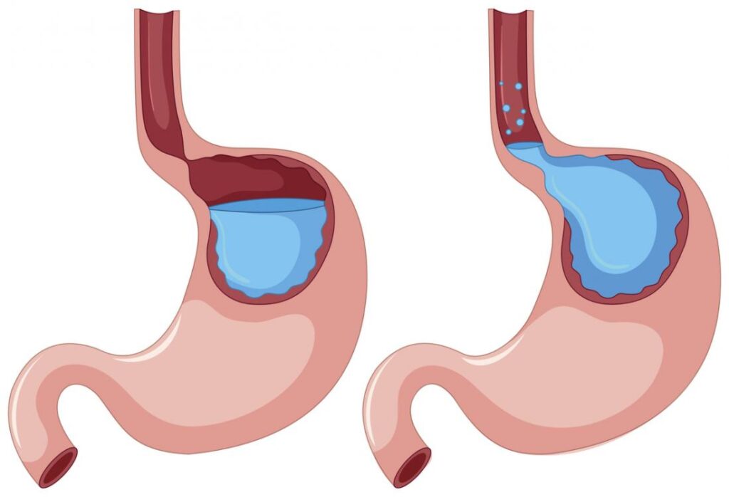 ACID REFLUX: COMMON QUESTIONS ANSWERED