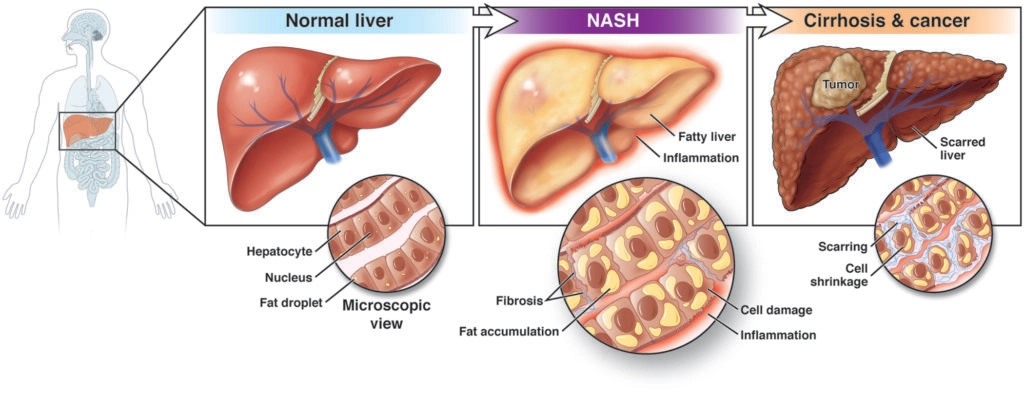 NON-ALCOHOLIC FATTY LIVER DISEASE (NASH)