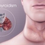 Hypothyroidism Emerges as Major Health Concern in Kashmir
