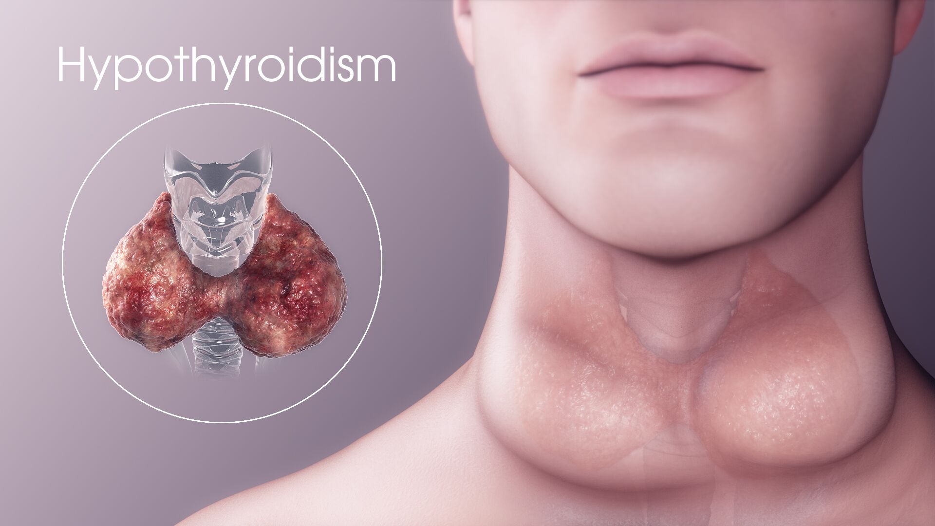 Hypothyroidism Emerges as Major Health Concern in Kashmir